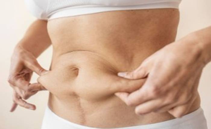 Guide to Diastasis Recti Treatment in Singapore Screenshot 1